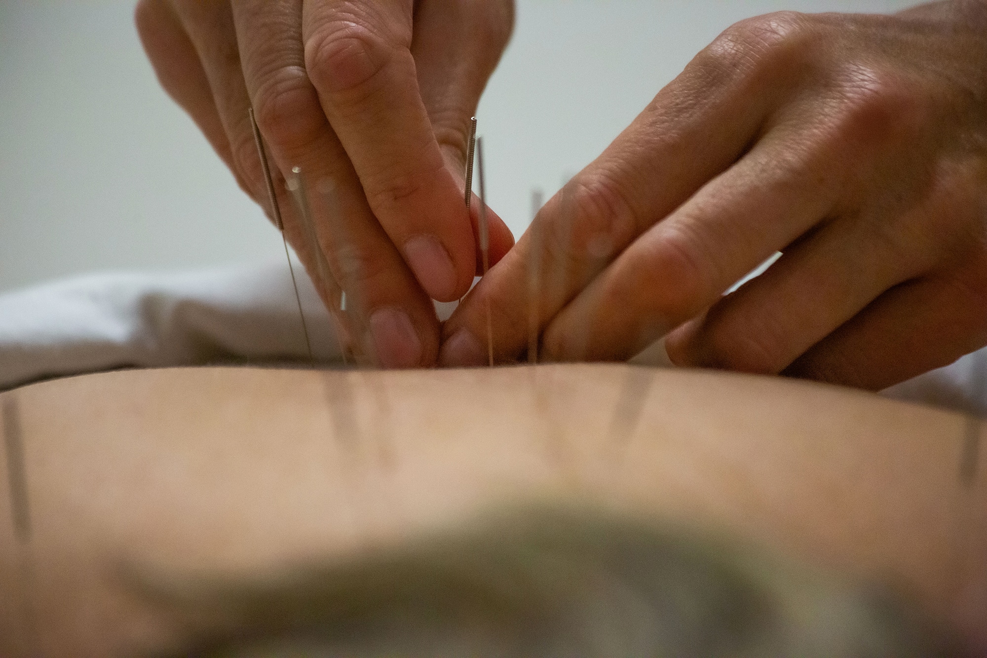 Acupuncture needles being inserted into skin