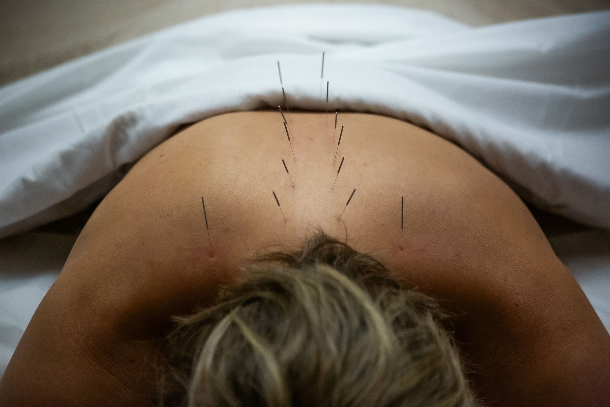 Acupuncture needles on back under a towel.