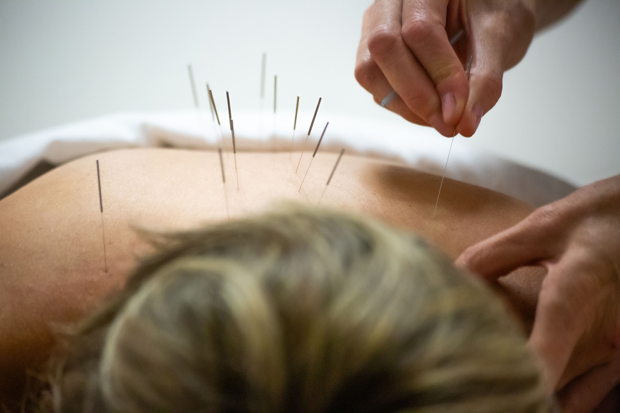 Acupuncture needles on back during therapy session.