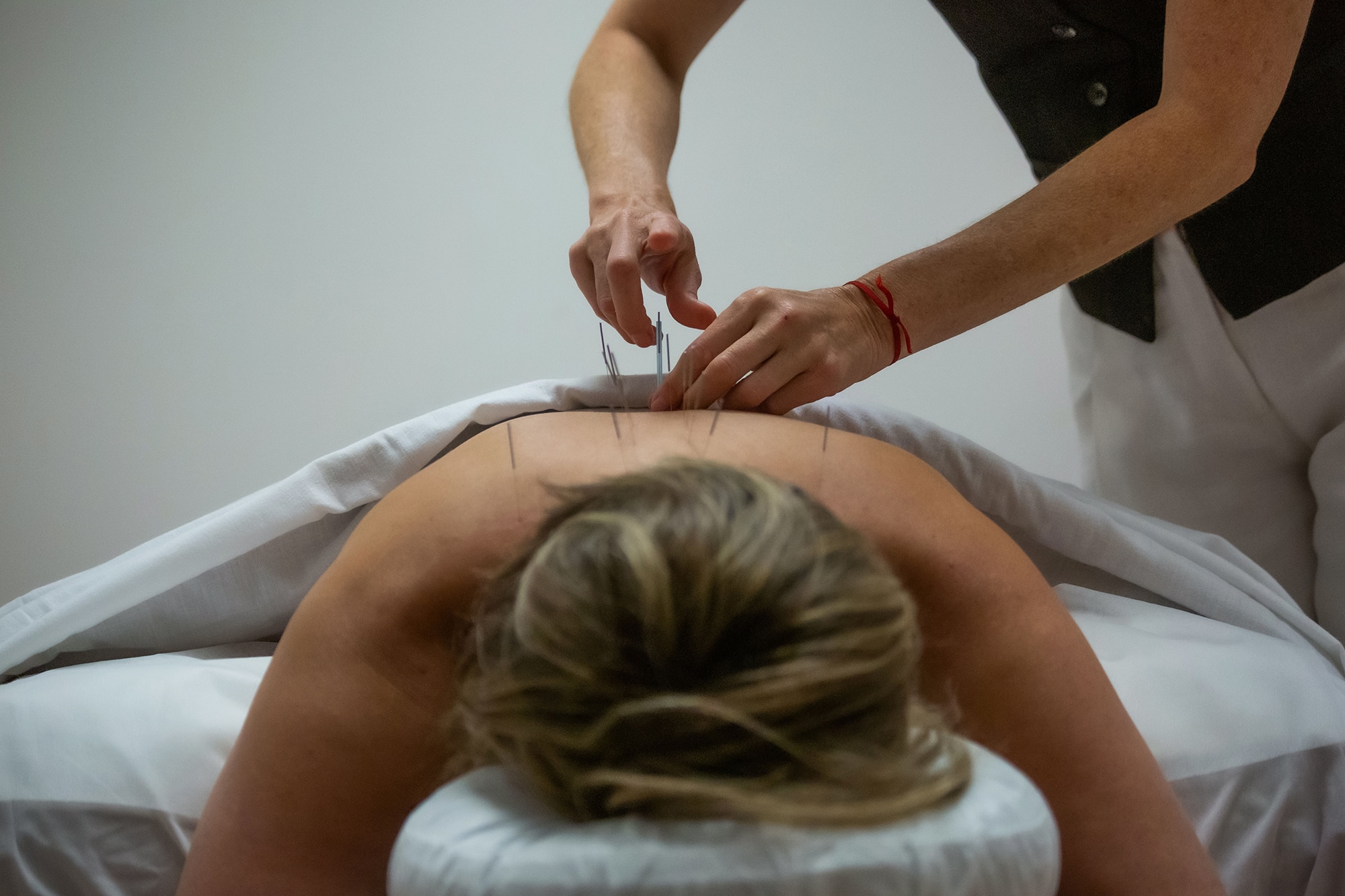 Acupuncture treatment on woman's back.