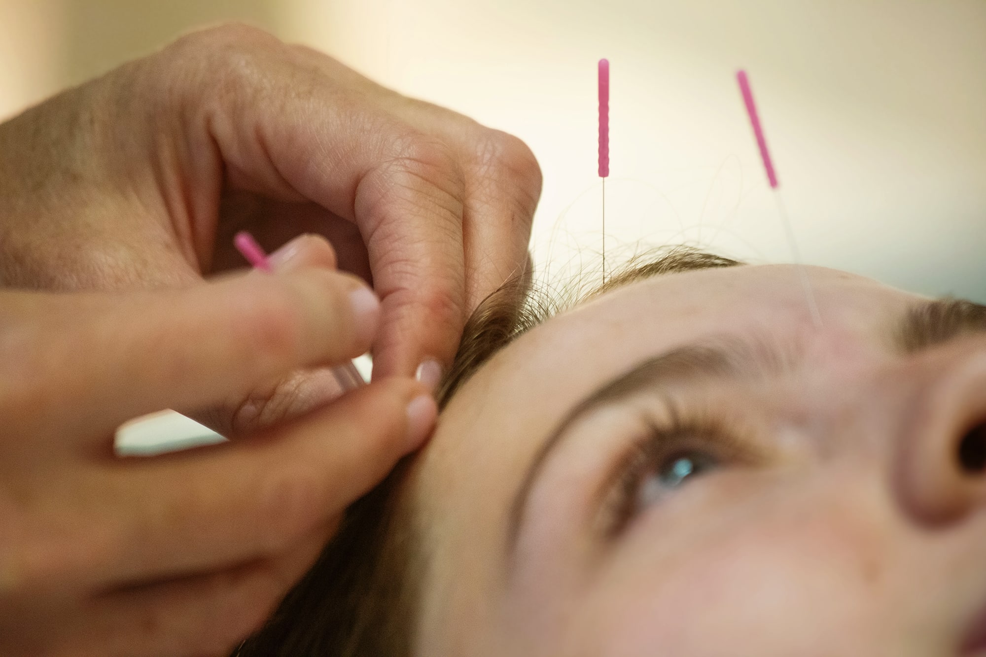 Acupuncture needles inserted on a person's forehead.