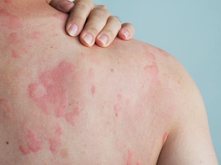 patient with hives on skin