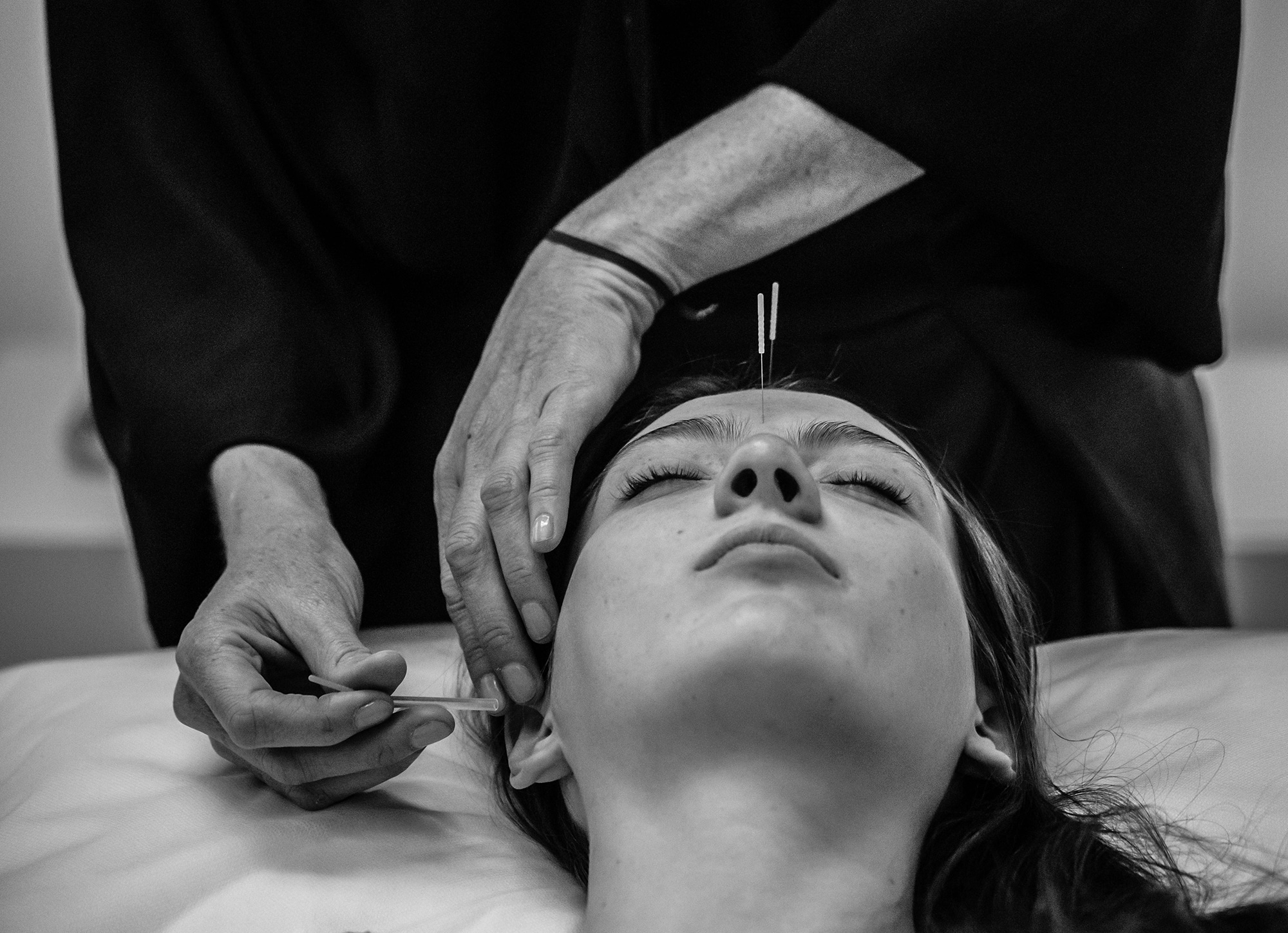 Acupuncture session with needles on forehead and ear.