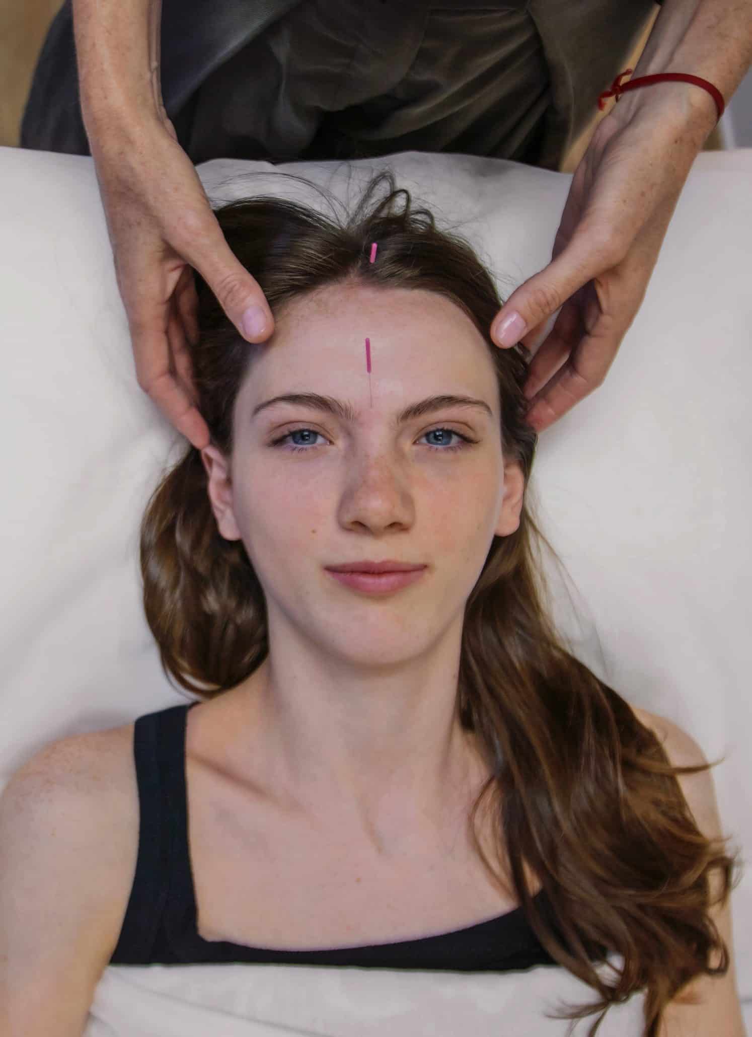 Woman receiving acupuncture on forehead