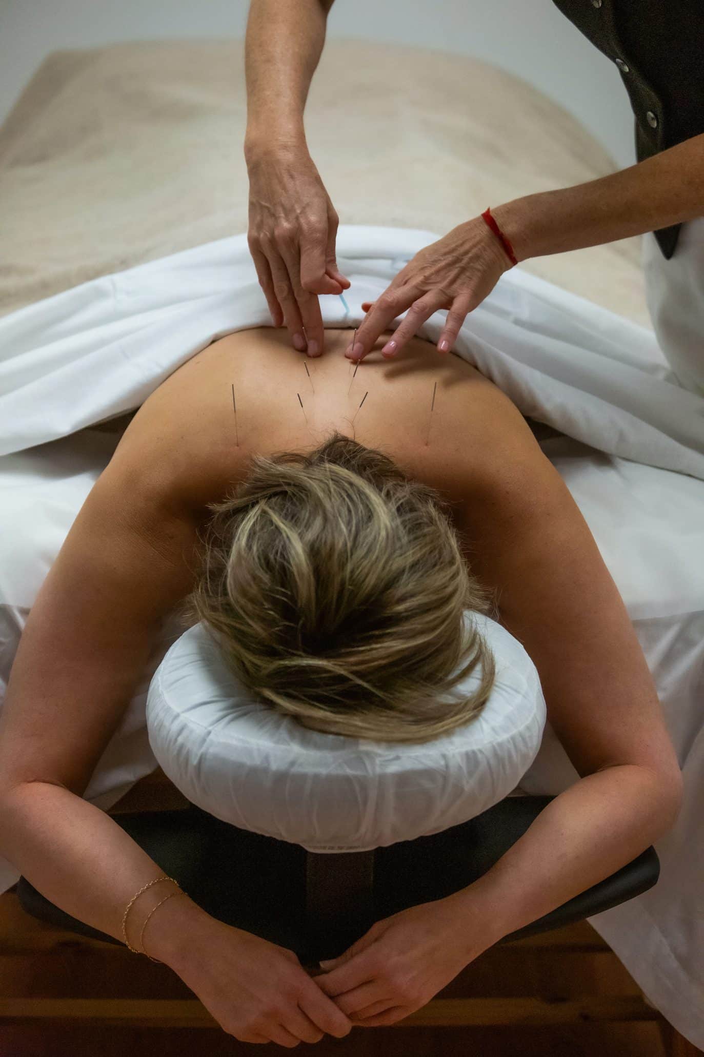 Person receiving acupuncture therapy on back.