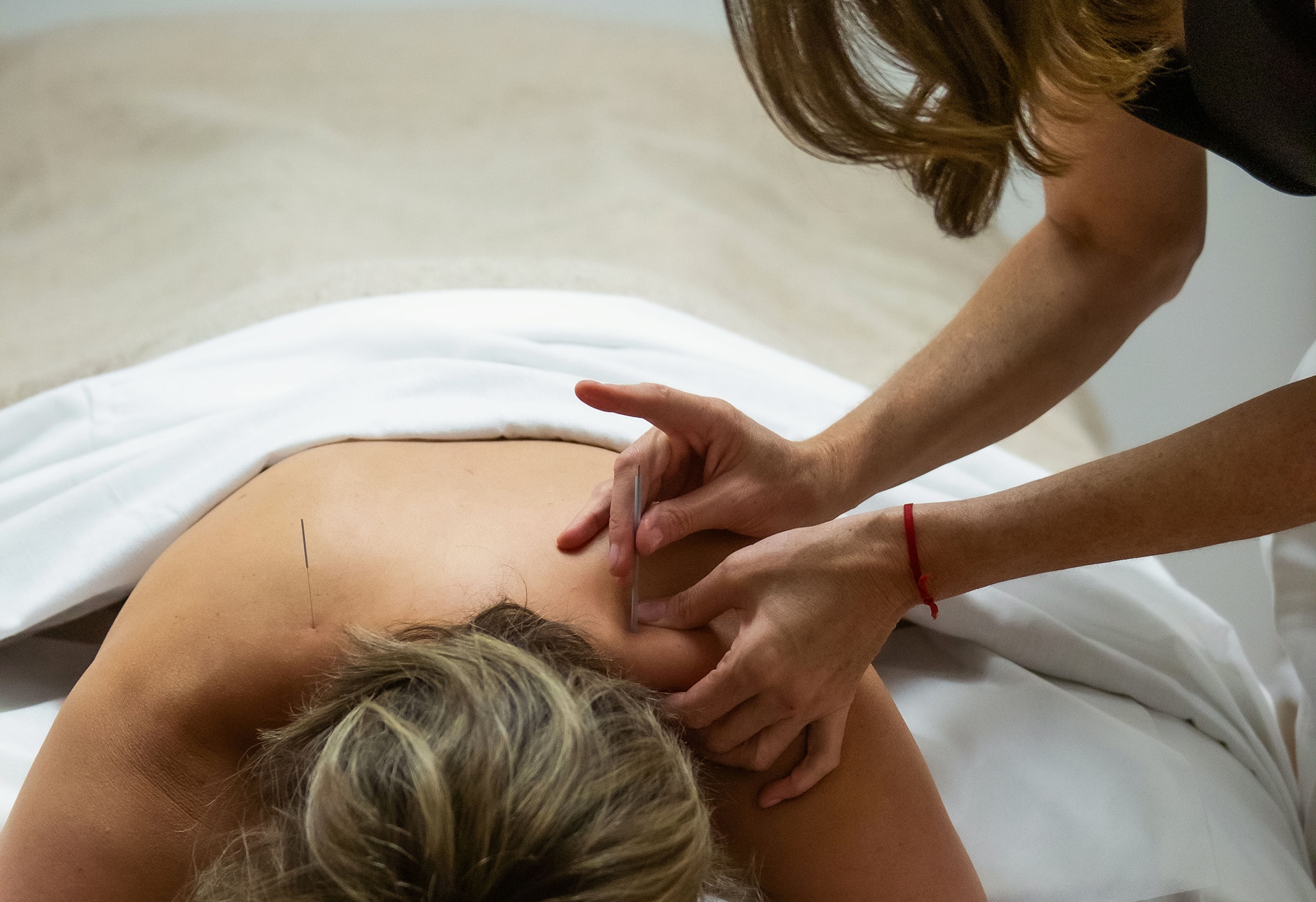 Person receiving acupuncture therapy on shoulder