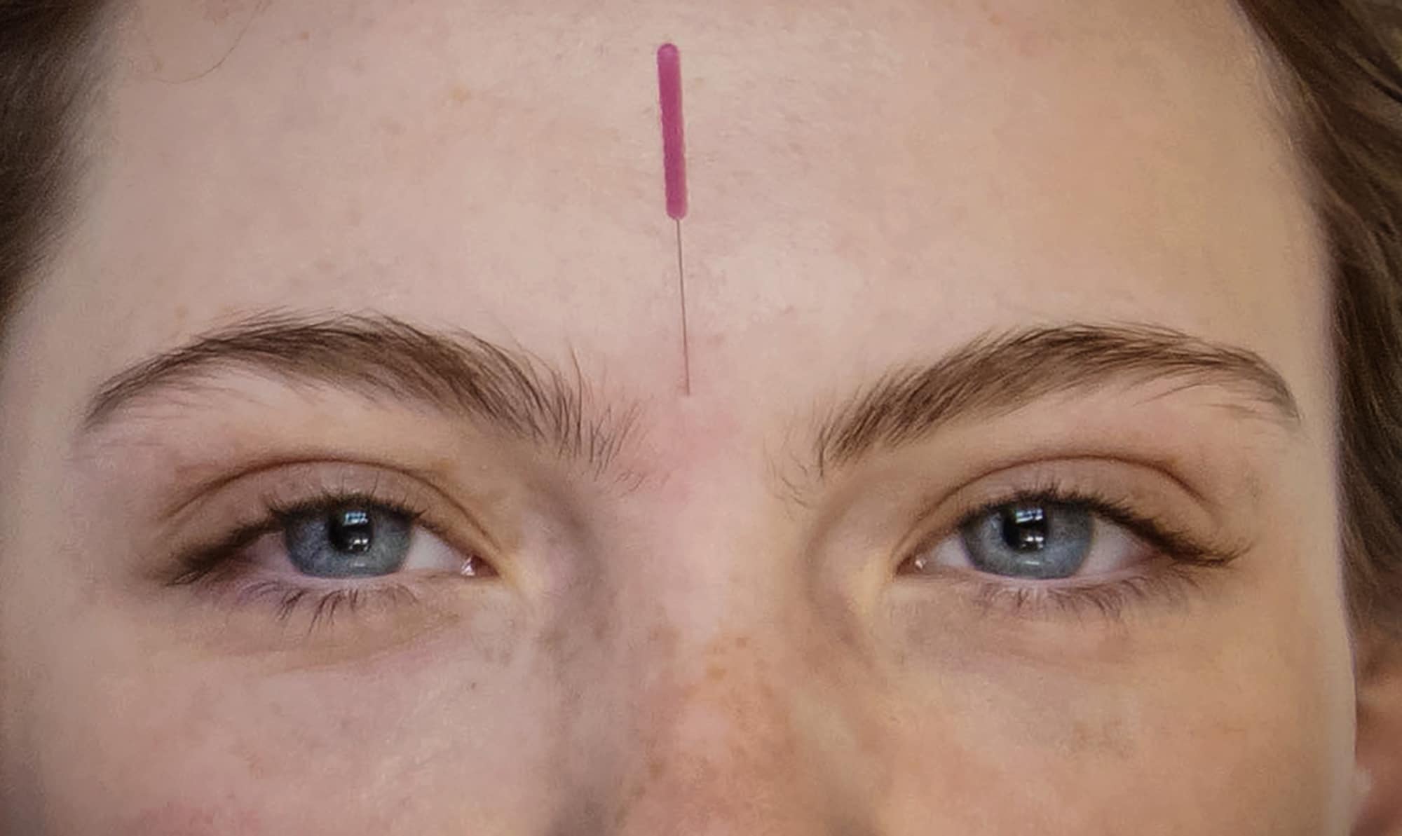 Acupuncture needle on forehead for relaxation therapy.