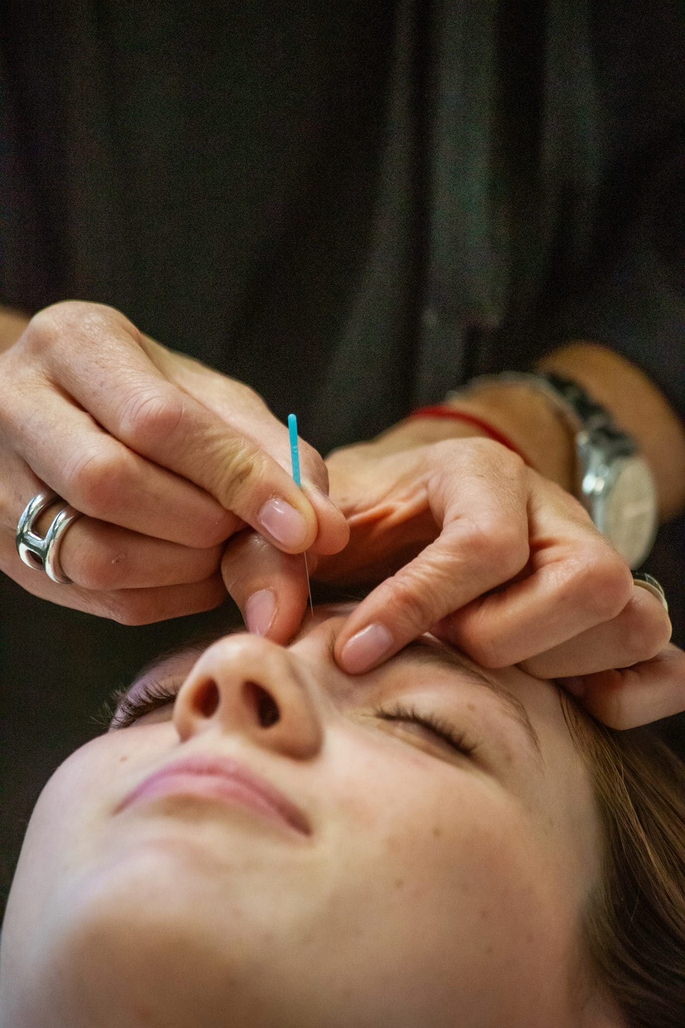Person receiving acupuncture needle facial treatment.