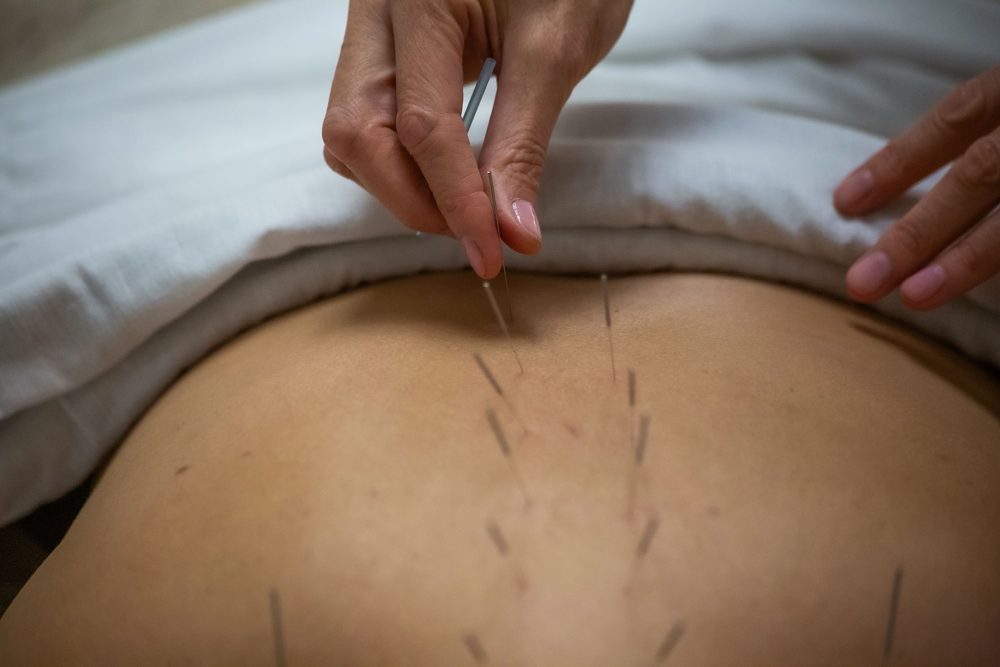 Acupuncture needles in a person's back