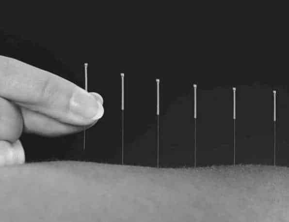 Acupuncture needles placed in skin